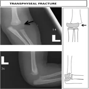 Transphyseal fracture